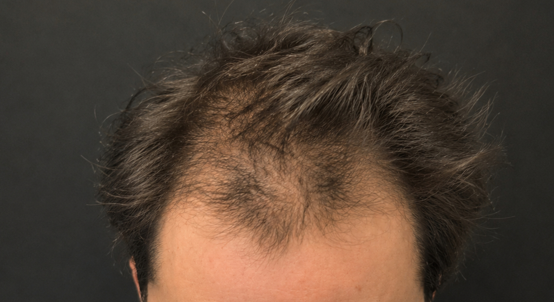 Antes — cabelo pré-transplante